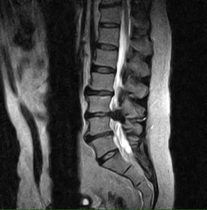 Lumbar MRI showing disc degeneration and large herniated disc
